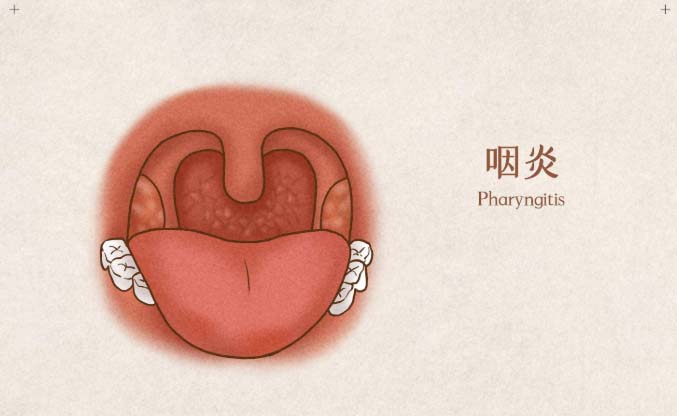 中醫(yī)解讀咽炎：從認知到防