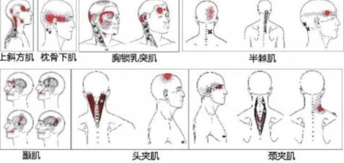 頭痛：探尋病因與應(yīng)對(duì)之道