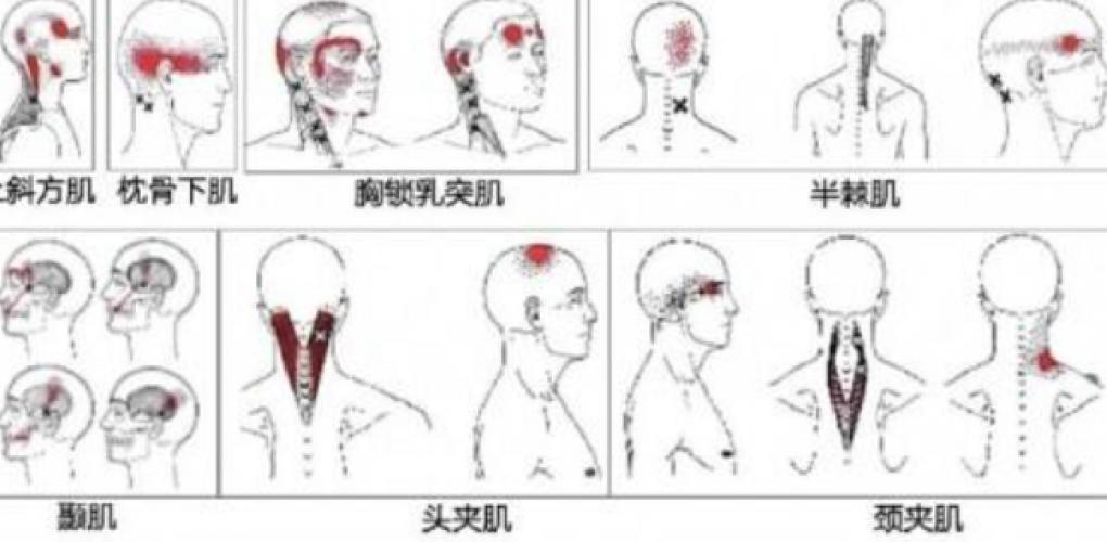 頭痛：探尋病因與應(yīng)對(duì)之道